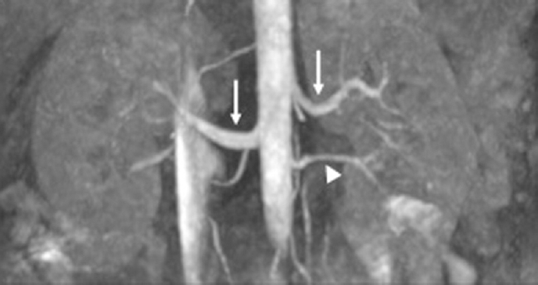 Non-contrast magnetic resonance angiography of ArTery and VEins 3D True fast imaging with steady-state precession unenhanced magnetic resonance angiography in a 45 yr old hypertensive male with chronic kidney disease showing bilateral normal renal arteries (arrows). Left inferior accessory renal artery (arrowhead).